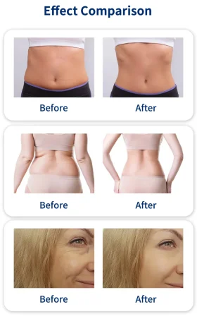 Metafora kozmeticki laseri