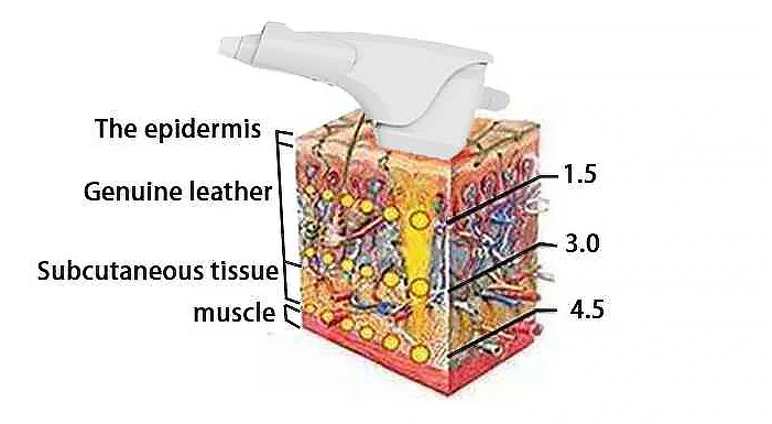 Metafora kozmeticki laseri