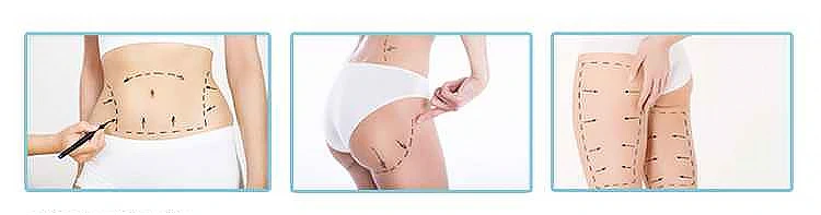 Metafora kozmeticki laseri