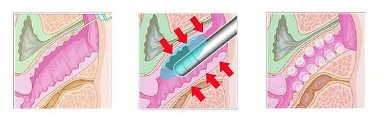 Metafora kozmeticki laseri