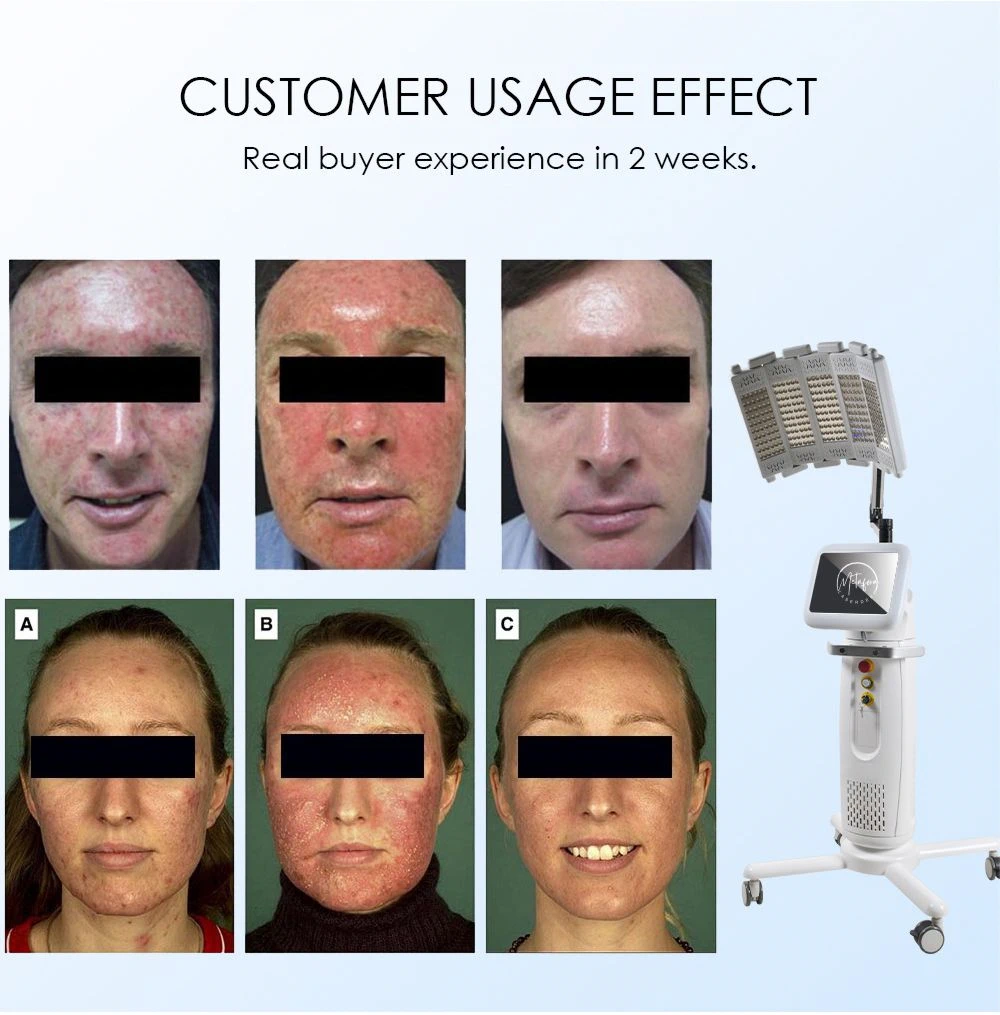 Metafora kozmeticki laseri