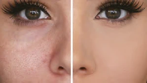 Metafora kozmeticki laseri